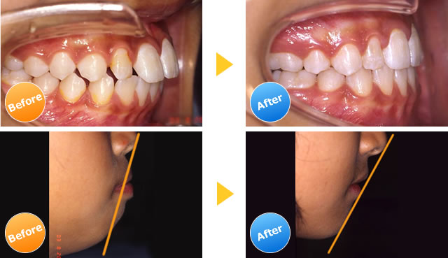 見えない矯正 Com千葉 東京 上下出っ歯をインビザラインで治す治療例 期間