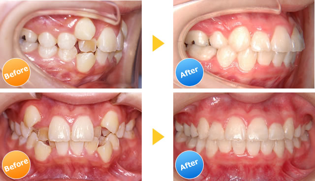 八重歯・叢生