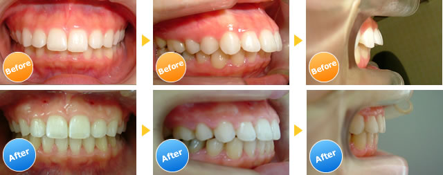 見えない矯正 Com千葉 東京 歯茎が目立つガミースマイルのインビザライン治療例