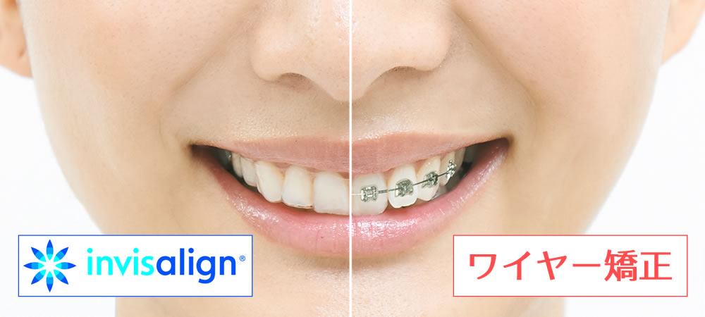 次世代のマウスピース矯正